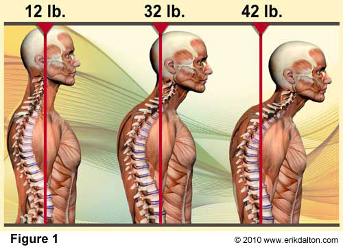 Bad Posture Causes Arthritis?!?!: Advanced Back & Neck Pain Center:  Chiropractic